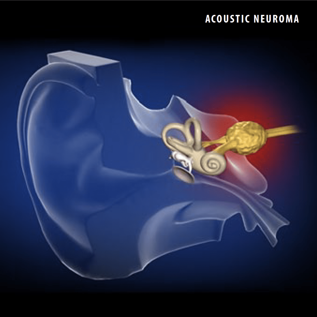 Acoustic Neuroma Nashville Neurosurgery Associates
