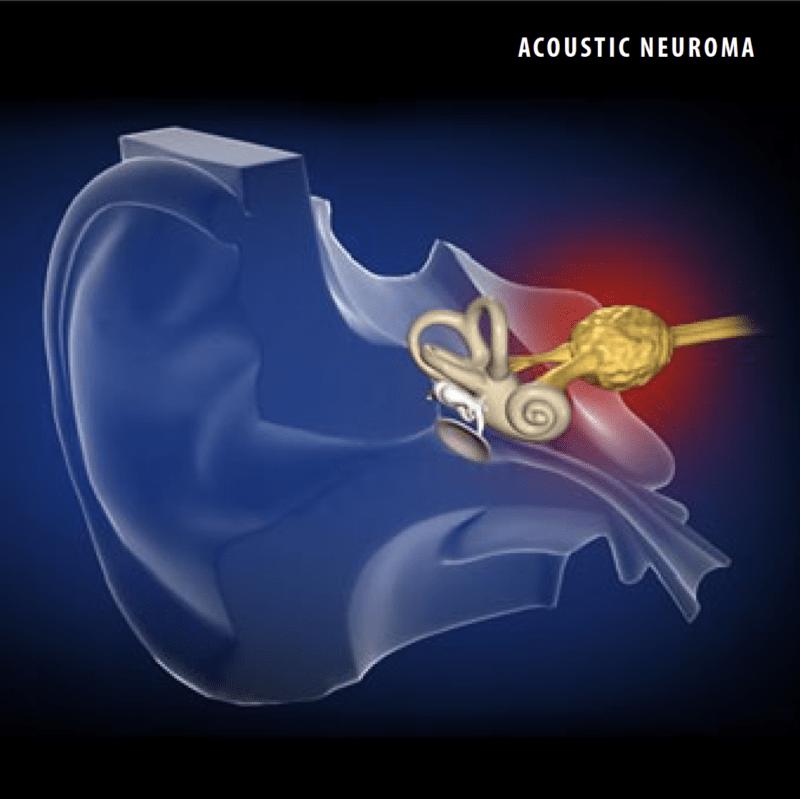 Acoustic Neuroma Nashville Neurosurgery Associates