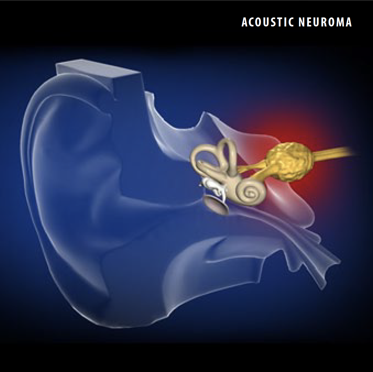 Acoustic Neuroma