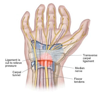 Carpal Tunnel Syndrome - Nashville Neurosurgery Associates