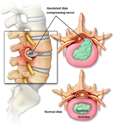 Icd 9 Code For Cervical Herniated Nucleus Pulposus