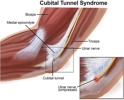 Cubital Tunnel Syndrome - Nashville Neurosurgery Associates