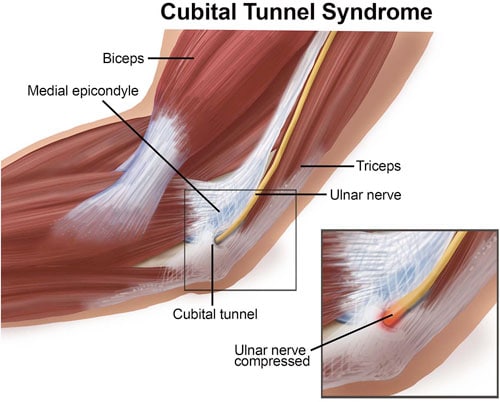 cubital tunnel icd 10 left
