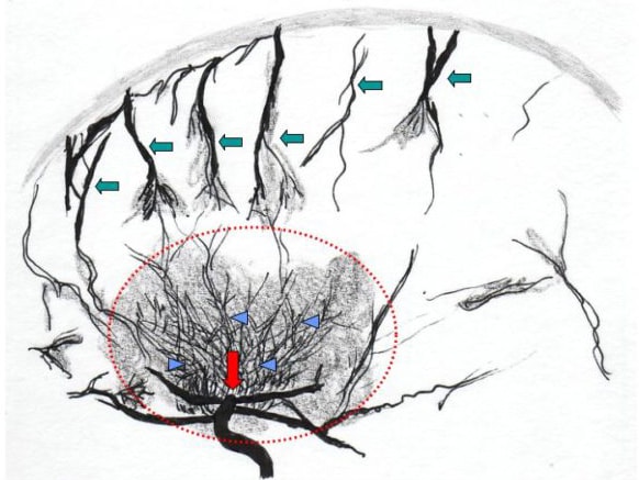 Moyamoya Disease - Nashville Neurosurgery Associates