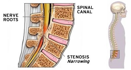 severe spinal stenosis icd 10
