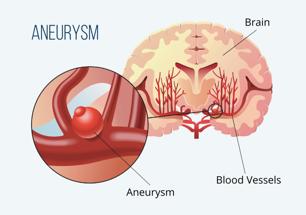 Migraine vs. Aneurysm Nashville Neurosurgery Associates(00)